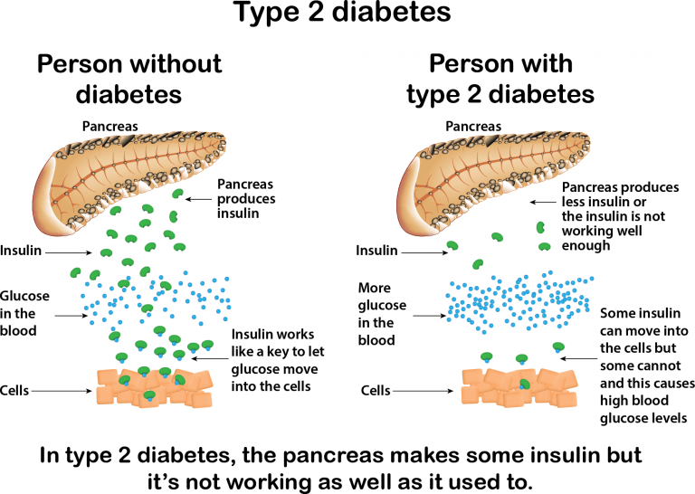 Background | Type II Diabetes