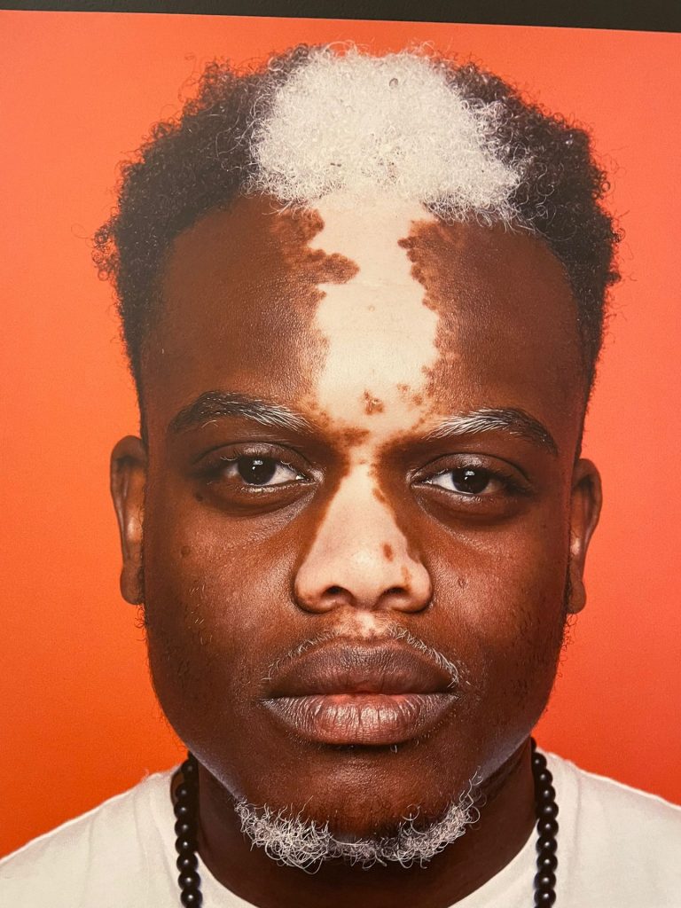 A black man with vitiligo in the centre of his face 
