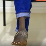 Swollen, diseased foot of a black child sitting in a chair on a shiny floor