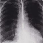 Black and white poster showing x-ray of smoke affected lungs