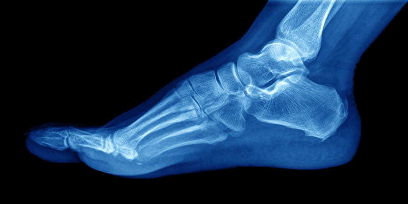 an Xray of the foot